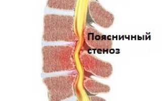 Спинальный стеноз поясничного отдела позвоночника