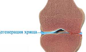 Причины опухшего колена и боли