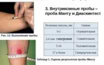 Заболел после диаскинтеста