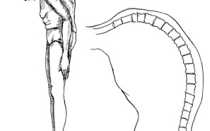 Болезнь анкилозирующий спондилоартрит