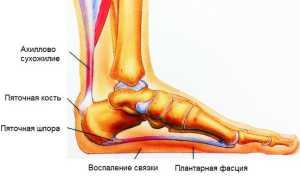 Причины боли стопы при ходьбе